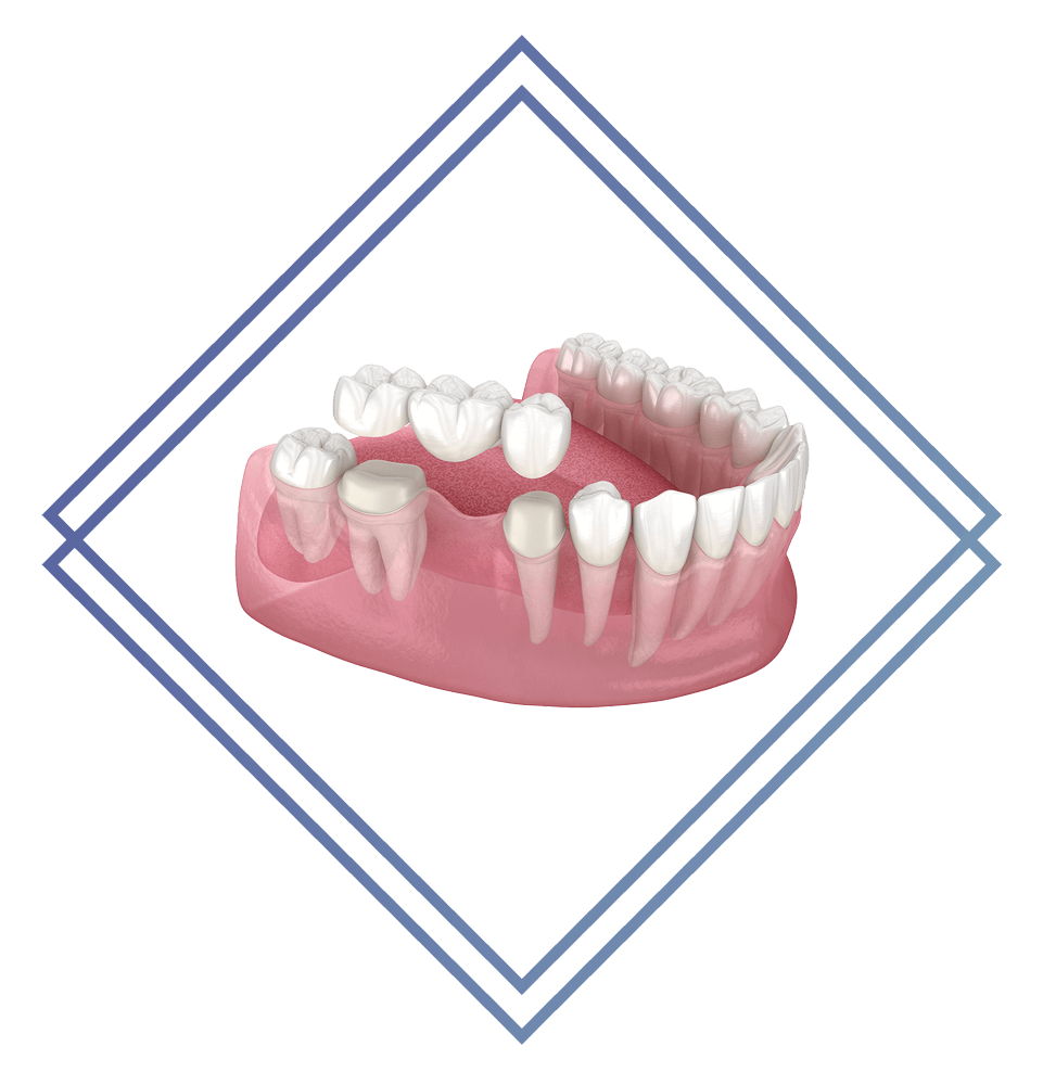 illustration of dental bridge