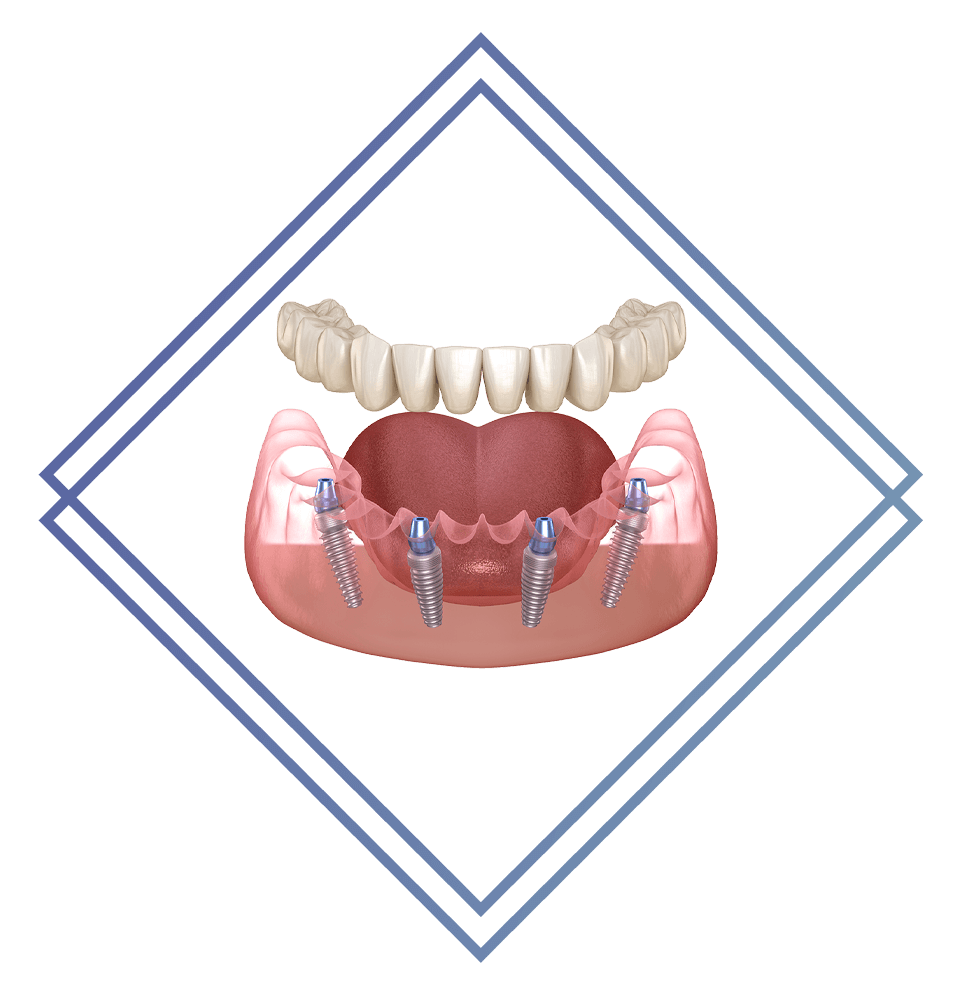 full arch dental implant illustration model