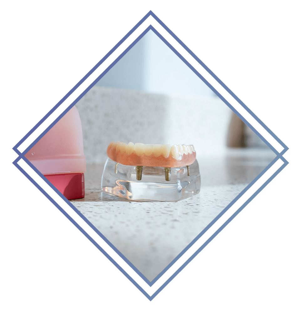 model of dental implant