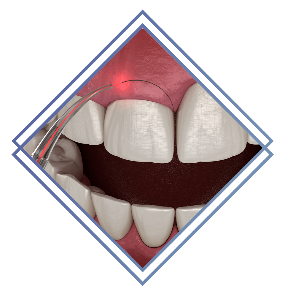 laser gum treatment illustration
