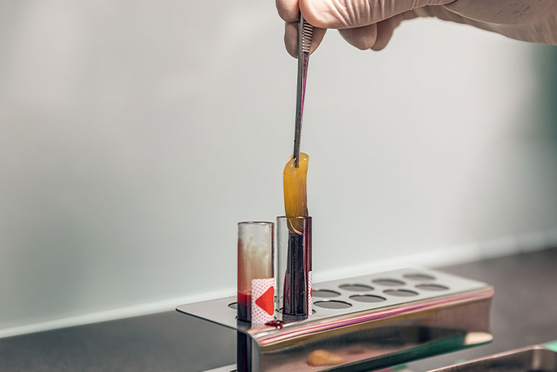 Plateletr rich fibrin