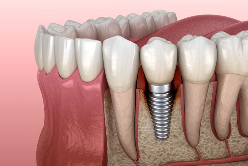 illustration of single dental implant