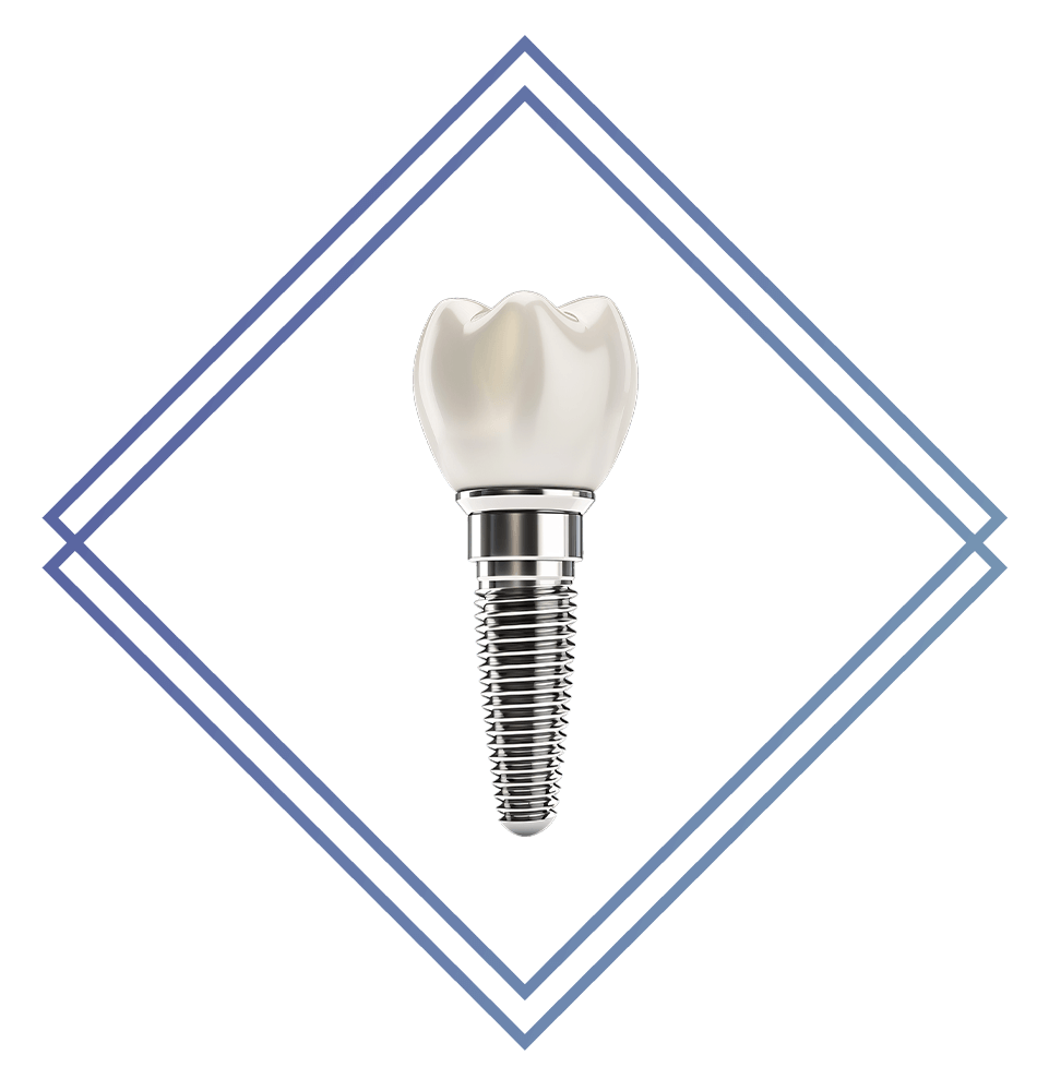 illustration of single dental implant