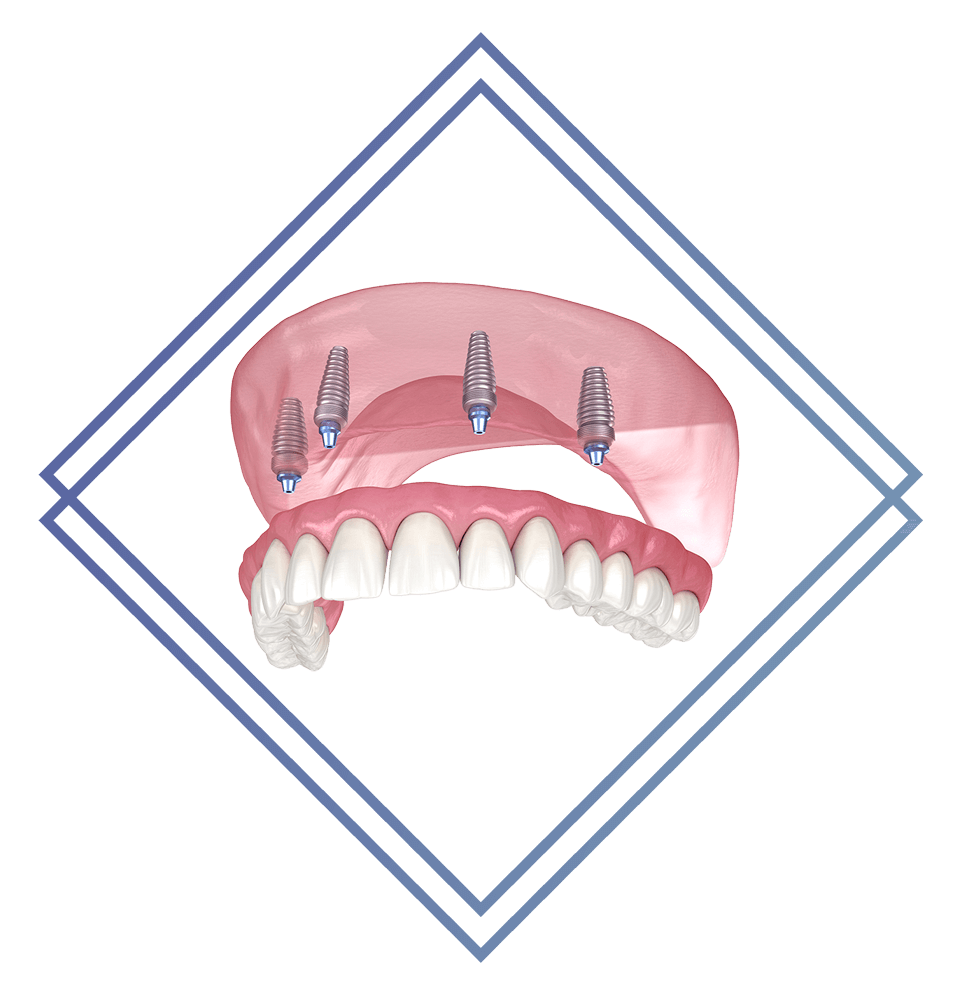 full arch dental implant illustration model